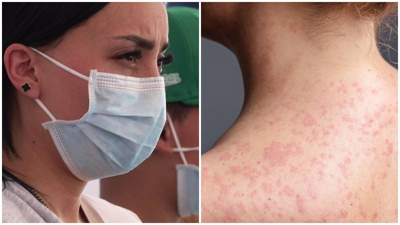 El brote de sarampión en Xalapa suma 16 casos confirmados, de los cuales, dos fallecieron; Salud