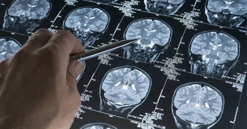 Nueva hipótesis sugiere que la deficiencia de litio podría desencadenar el Alzheimer