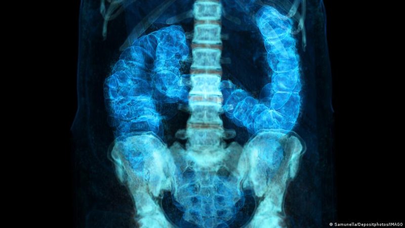 Aumento del cáncer de colon en América Latina